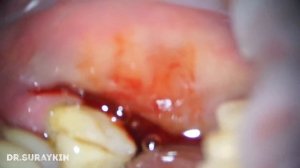 Удаление нижнего восьмого зуба , удаление восьмерки , удаление зубы мудрости , вырвать зуб мудрости