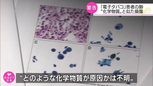 電子たばこ使用した患者の肺 有毒物質吸引と同様の組織損傷 смотреть онлайн