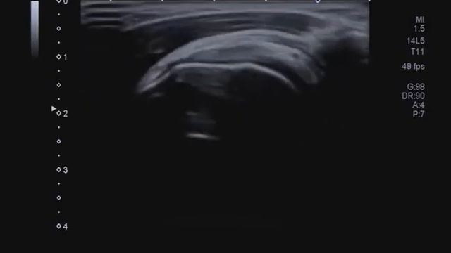 Сухожилие надостной мышцы в положении Красса смотреть онлайн