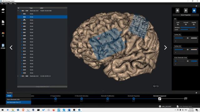 Intracranial EEG Montage Creator ECoG Grid placement смотреть онлайн