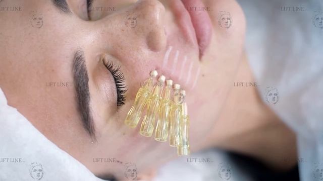 Коррекция носогубных складок нитями Screw Lift Line Nata смотреть онлайн