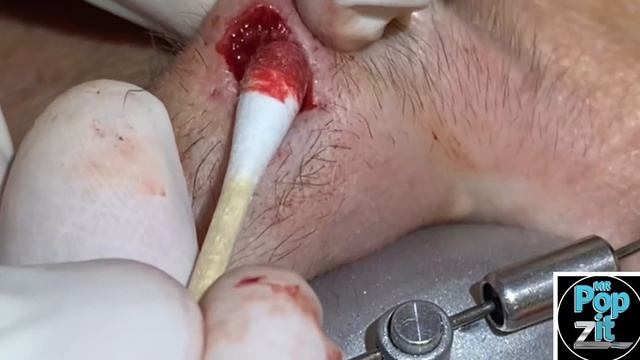 Pocket full of Pebbles cyst. One of a kind pebble pop! You’ve never seen a pebble cyst pop before. смотреть онлайн