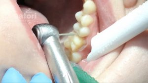 Металлокерамические коронки, клинические этапы протезирования | стоматология Самара