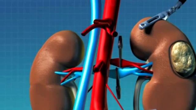 2 Киста почки что это такое и лечение смотреть онлайн