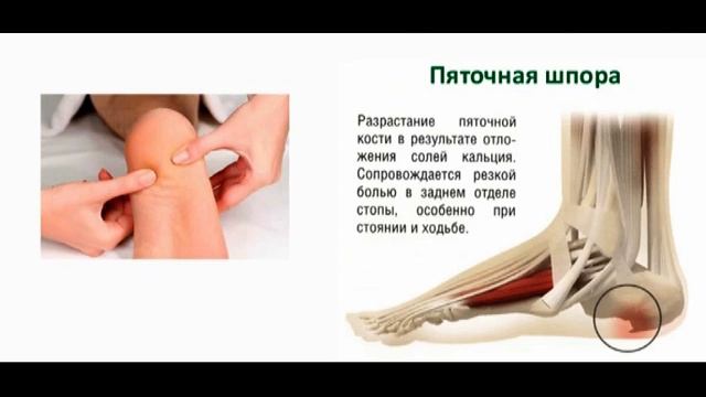 Как быстро избавиться от пяточной шпоры/Болит пятка! Причины боли в пятке/Средства от пяточной шпор смотреть онлайн