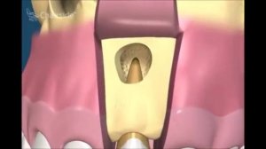 Хирургическая стоматология  Удаление кисты зуба и резекция корня зуба.