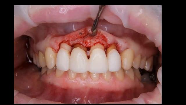 Biological Width Violation Case for Discussion in Russian смотреть онлайн