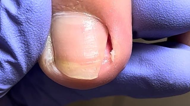 Lots of pus out, paronychia trimmed, crazy ingrown nails【Doctor Liu Pedicure】 смотреть онлайн