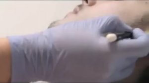 Epilium  Лазерная эпиляция области лица у мужчин 1