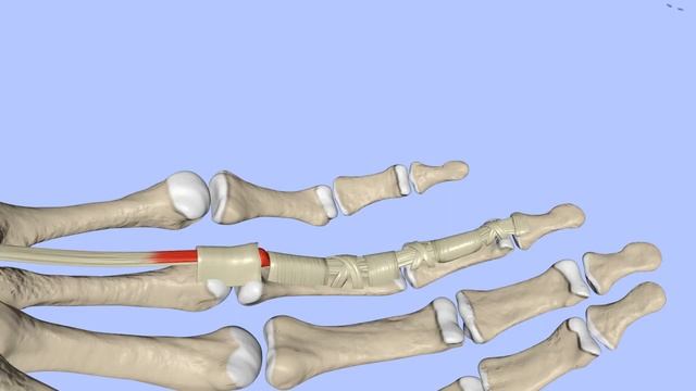 Щелкающий палец! Болезнь Нотта. Стенозирующий лигаментит. смотреть онлайн