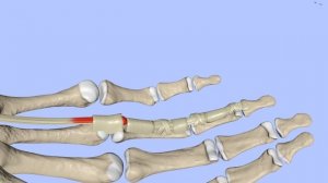 Щелкающий палец! Болезнь Нотта. Стенозирующий лигаментит.