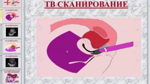 УЗИ малого таза женщин в норме Палёный А И