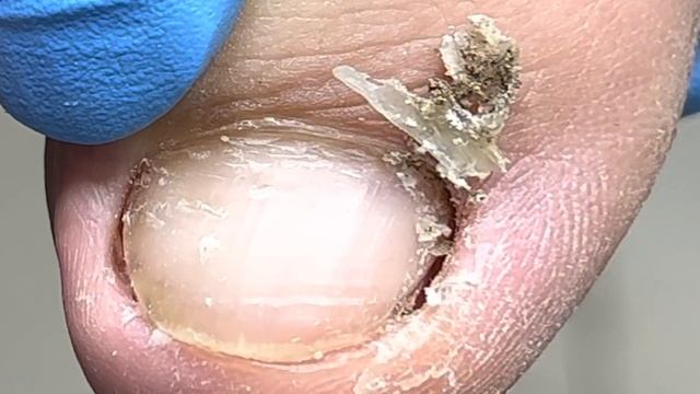 Comfortable! The dirt deep in the toenails was finally cleaned up 【Xue Yidao】 смотреть онлайн