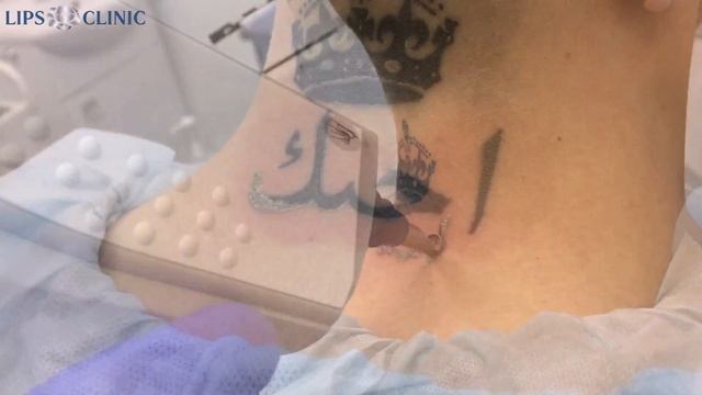 Удаление татуировок лазером смотреть онлайн