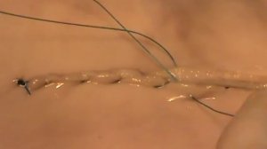 Кишечный шов Шмидена. Docent A.D. Stepanov, ПДАТУ