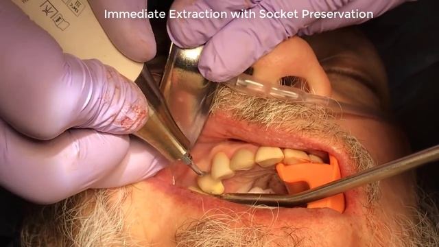 Piezotome CUBE Extraction with Dr Jeffrey Brooks DMD смотреть онлайн