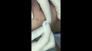 # 3 Большая черная точка\КАМЕДОН\Большой жировик\удаление черноголовых