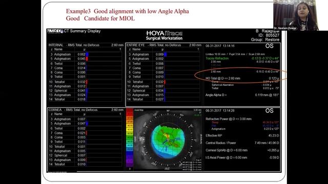 Lecture: Wavefront Aberrometry And ITrace: Screening And Planning Surgeries