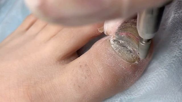 ОНИХОГРИФОЗ ?⚠️?❗️• Зачистка?? смотреть онлайн