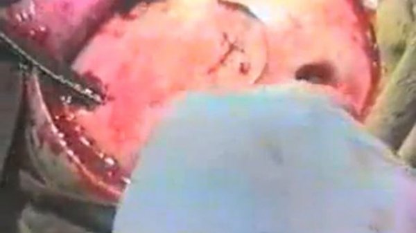 Трепанация черепа.flv