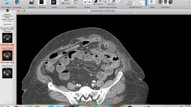 | GIT | ER | IO | obstructing hernia | Reporting Simulation смотреть онлайн
