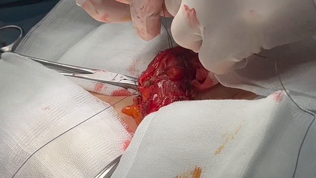 Закрытие колостомы (трансверзостомы). Loop colostomy closure. смотреть онлайн