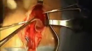 Пластика косой паховой грыжи