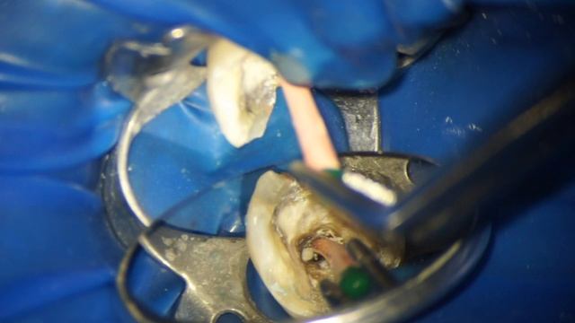 Закрытие перфорации и обтурация канала биокерамикой