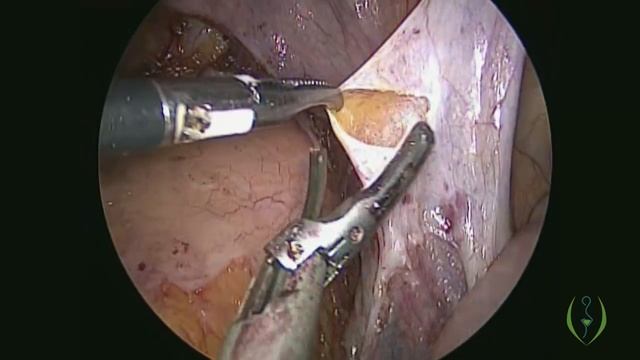 Laparoscopic Radical Hysterectomy with Pelvic Lymph Node Dissection смотреть онлайн