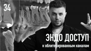 Эндодонтический доступ к облитерированным каналам. Уроки эндодонтии Дмитрия Николаева. Выпуск 34