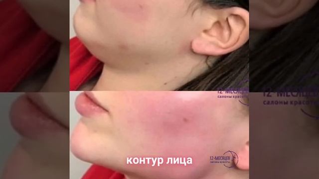 Акция на Филлеры - Салоны красоты "12 месяцев" смотреть онлайн