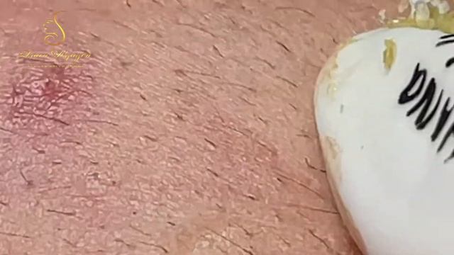 Professional bleckheads Выдавливание черных точек прыщей самое залипательное видео 2023 смотреть онлайн