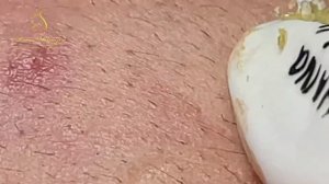 Professional bleckheads   Выдавливание черных точек прыщей   самое залипательное видео 2023