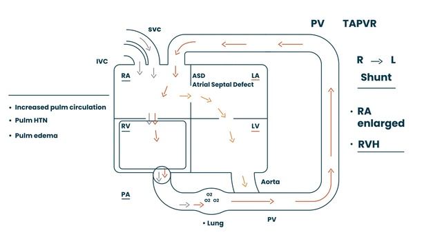 Total Anomalous Pulmonary Venous Return (TAPVR) смотреть онлайн