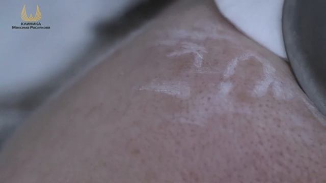 Удаление гиперпигментации смотреть онлайн