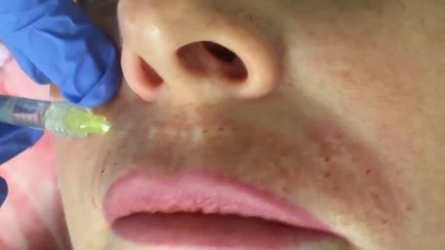 Коррекция морщин техникой Бланшинга смотреть онлайн