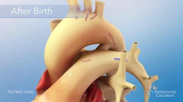 Patent Ductus Arteriosus (PDA) Occlusion Procedure