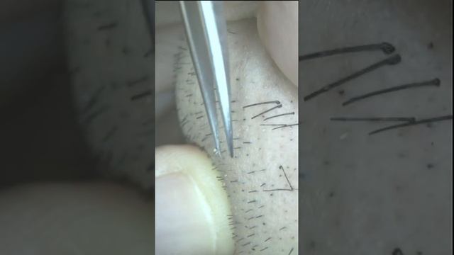 Пинцетом для удаления вросшей бороды for iPhone 2020/11/17 смотреть онлайн