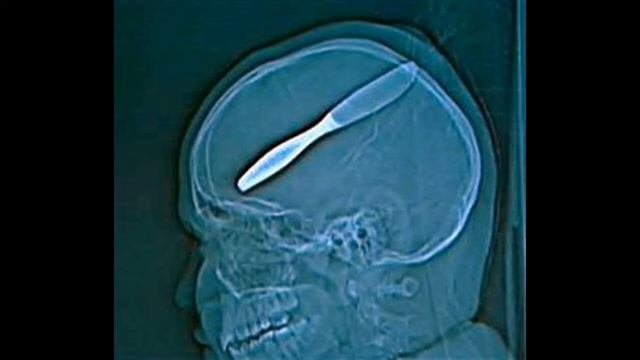 10 НЕОБЫЧНЫХ РЕНТГЕНОВСКИХ СНИМКОВ смотреть онлайн