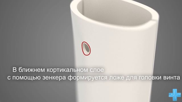 Принцип использования компрессирующего винта. Principles of the lag screw смотреть онлайн