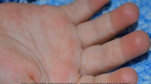 Почему у ребенка трескаются пальцы на руках