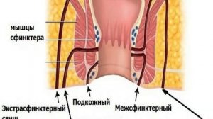 Свищ прямой кишки.  Парапроктит
