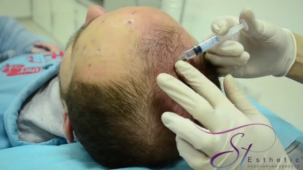 Лечение выпадения волос- мезороллер (методика). estet-portal.com