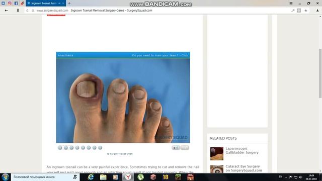 Удаление ногтя смотреть онлайн