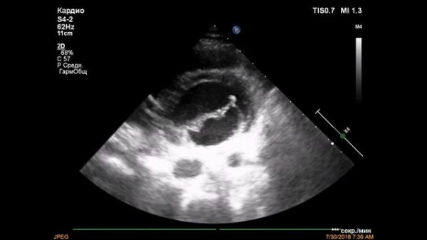 Парашютообразный митральный клапан