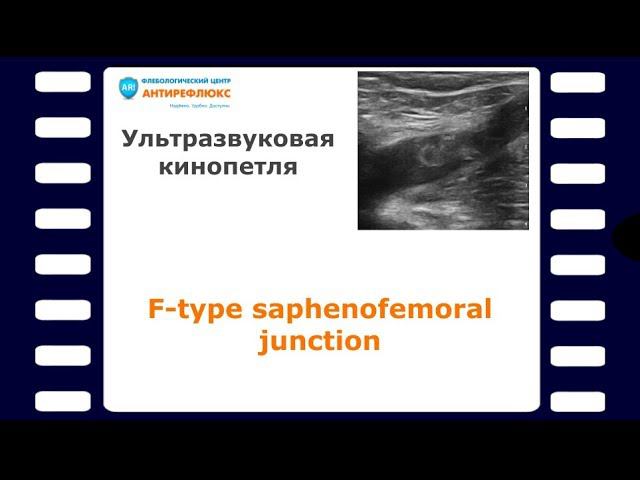 F-type saphenofemoral junction смотреть онлайн