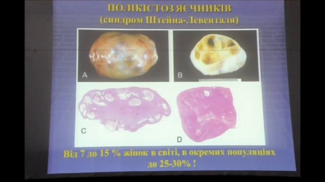 Патологічна фізіологія №12 Патофізіологія ендокринної системи; статева система смотреть онлайн