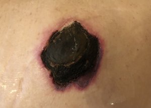 ?️ Стадии пролежней. NPIAP, EPUAP Pressure injury stages.mp4