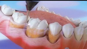 Лечение пародонтоза