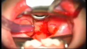 Аденотомия классическим методом под общим наркозом.mp4